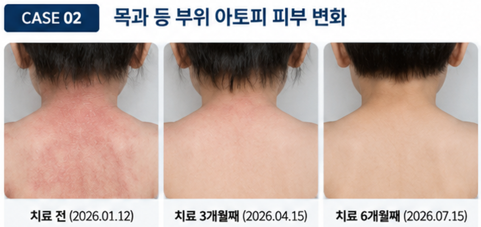 등 상부와 뒷목 아토피 치료 전 치료 3개월째 치료 6개월째