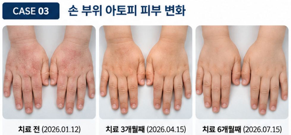 손등 아토피 치료 전 치료 3개월째 치료 6개월째