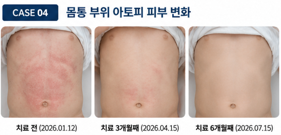 등 배 전체 아토피 치료 전 치료 3개월째 치료 6개월째