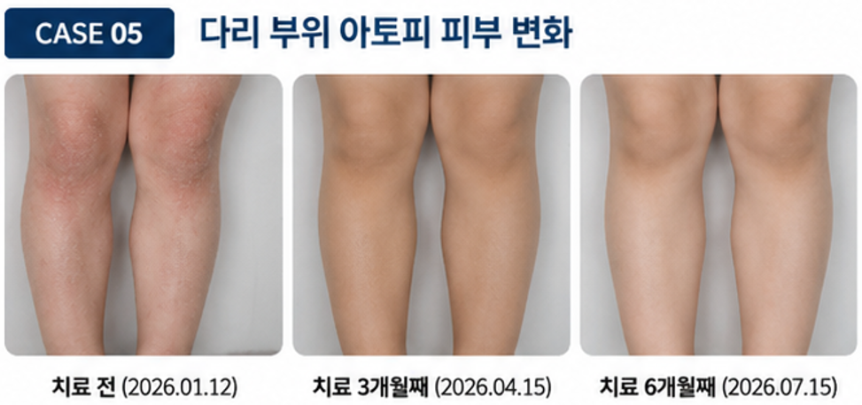다리 아토피 치료 전 치료 3개월째 치료 6개월째